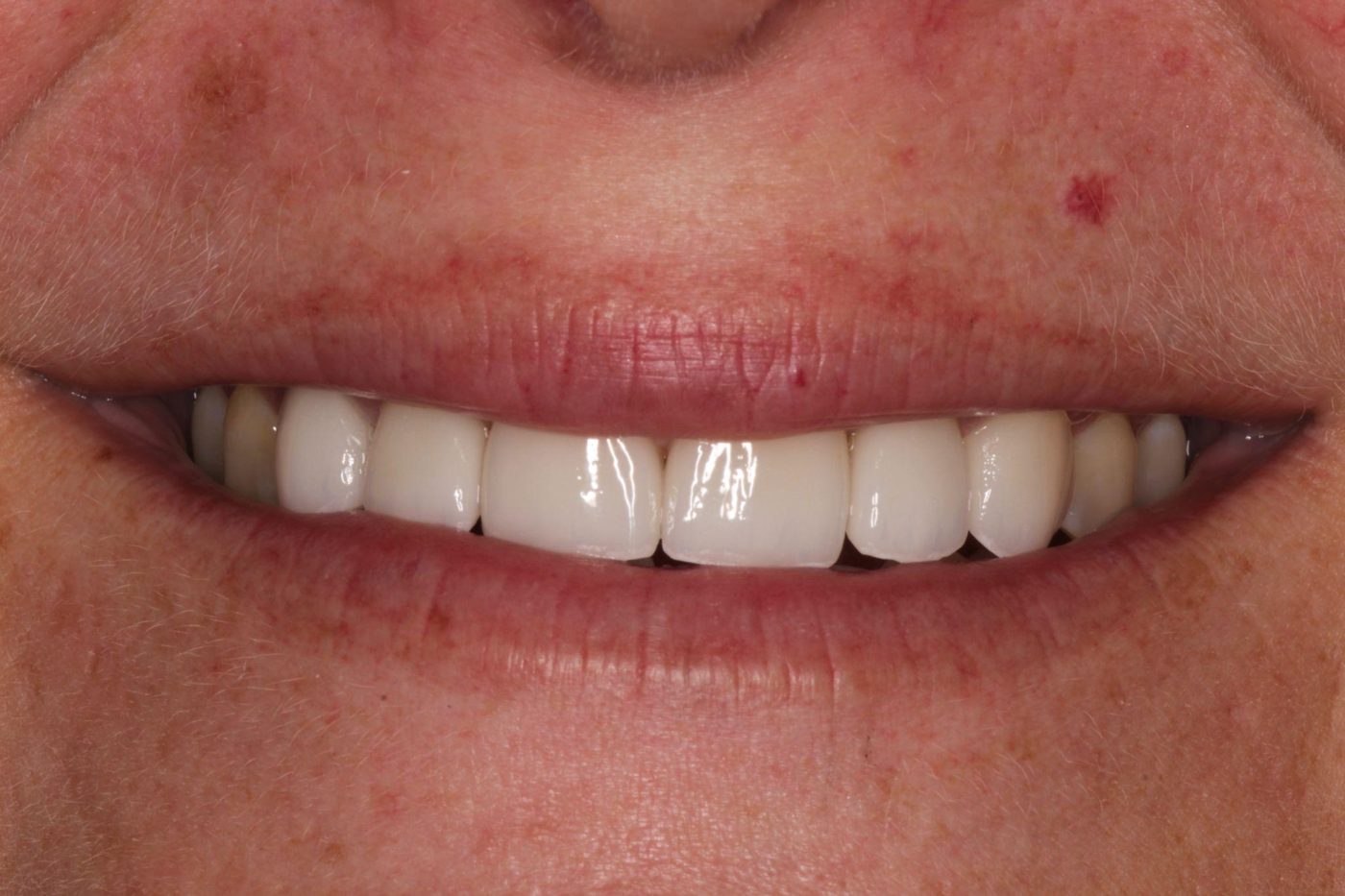 After: rebuilt natural smile after full mouth rehabilitation by Dr. Seth Calish, Clermont FL