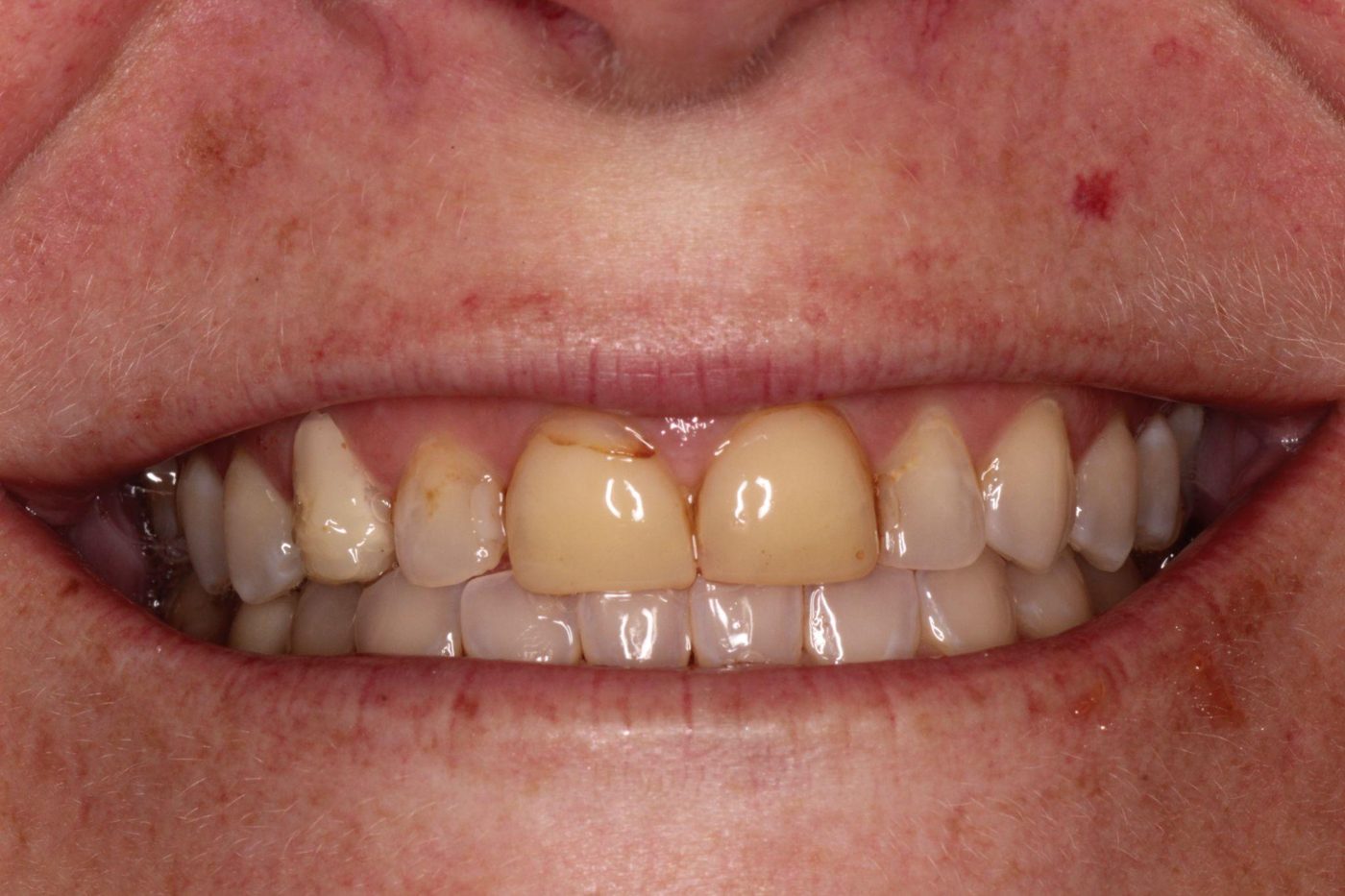 Before: discolored, failing older dental work before full mouth rehabilitation, Clermont FL