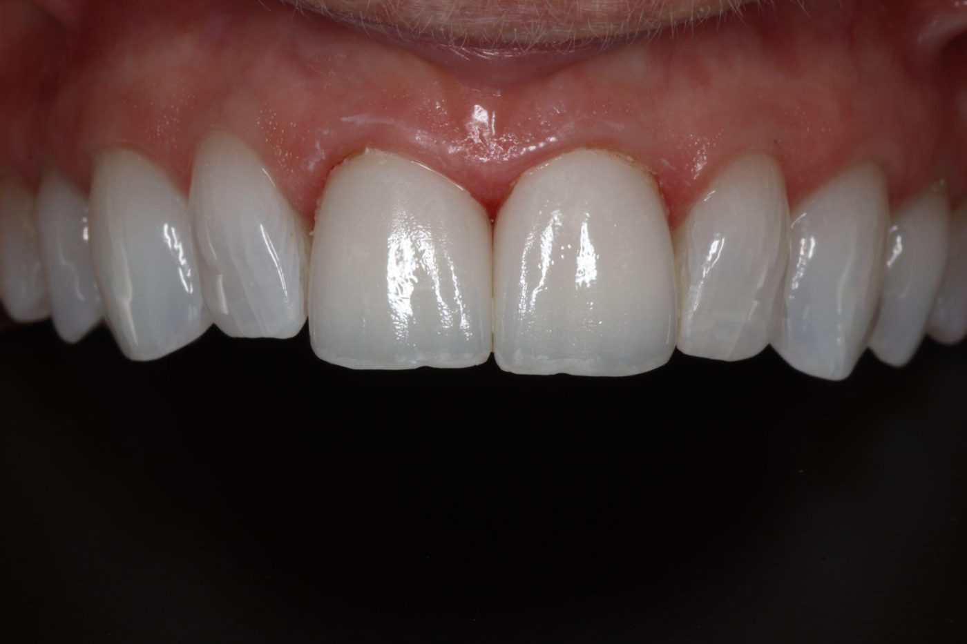 After: front tooth restored to blend invisibly with natural teeth, Clermont FL