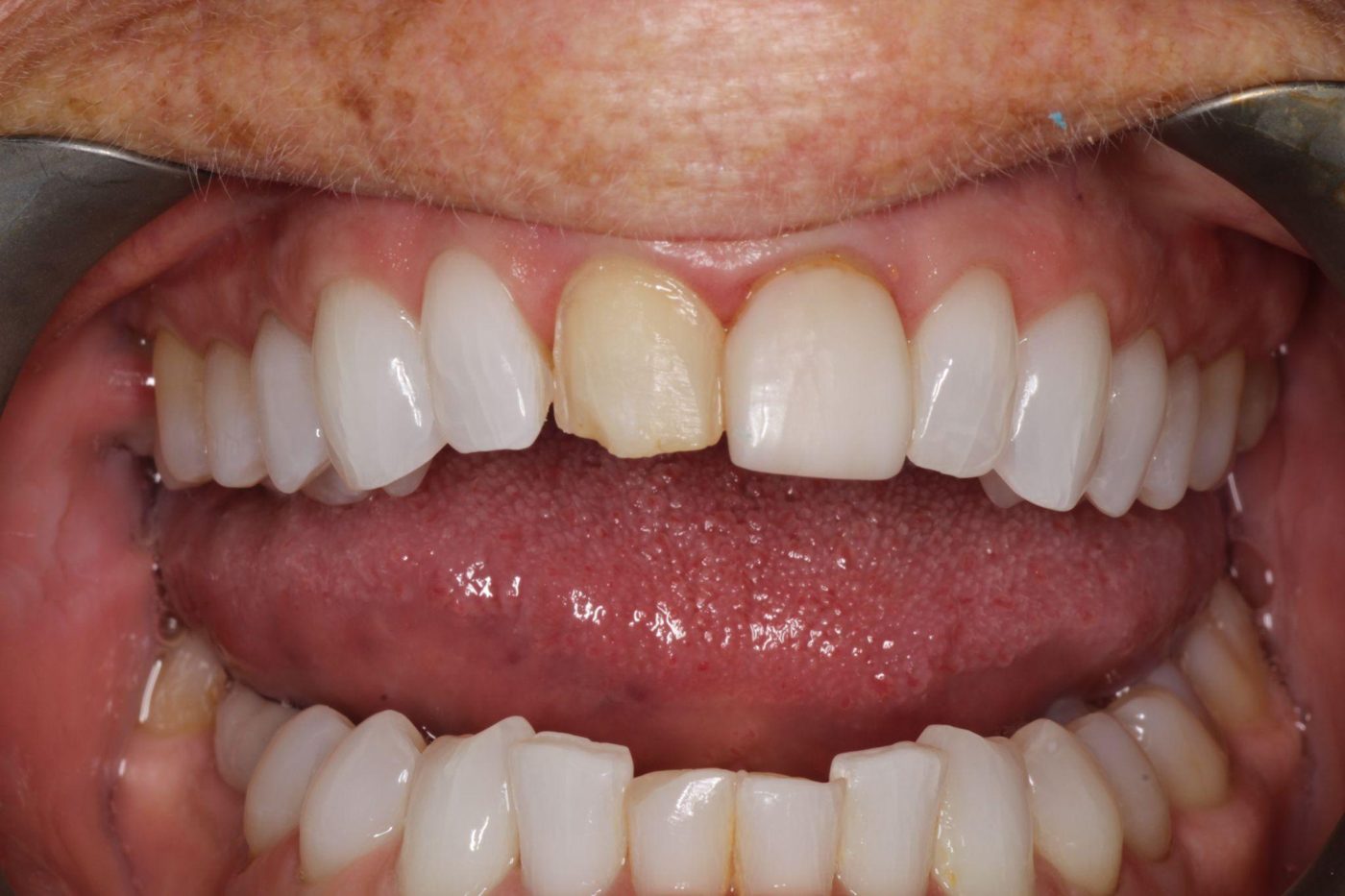 Before: single dark front tooth with old dental work, Clermont FL