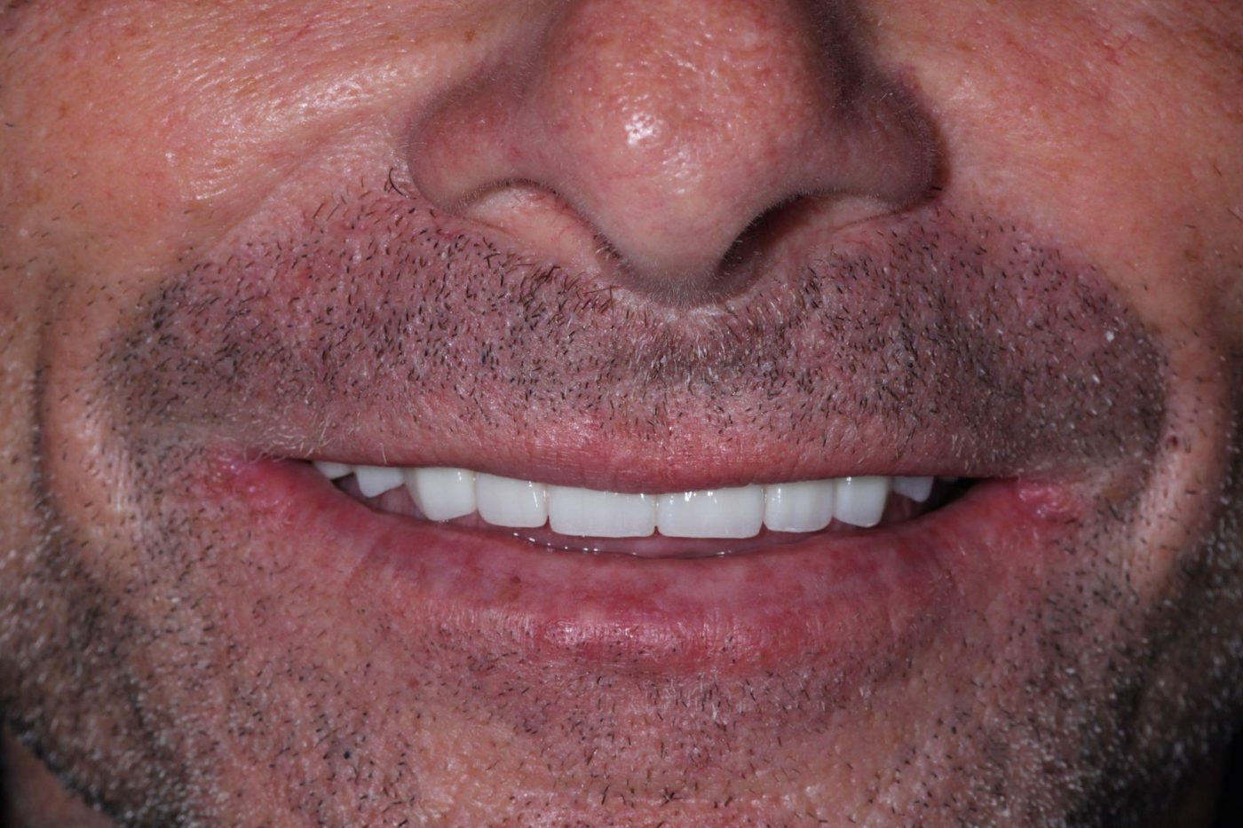 After: fixed natural-looking smile after implant reconstruction by Dr. Seth Calish, Clermont FL