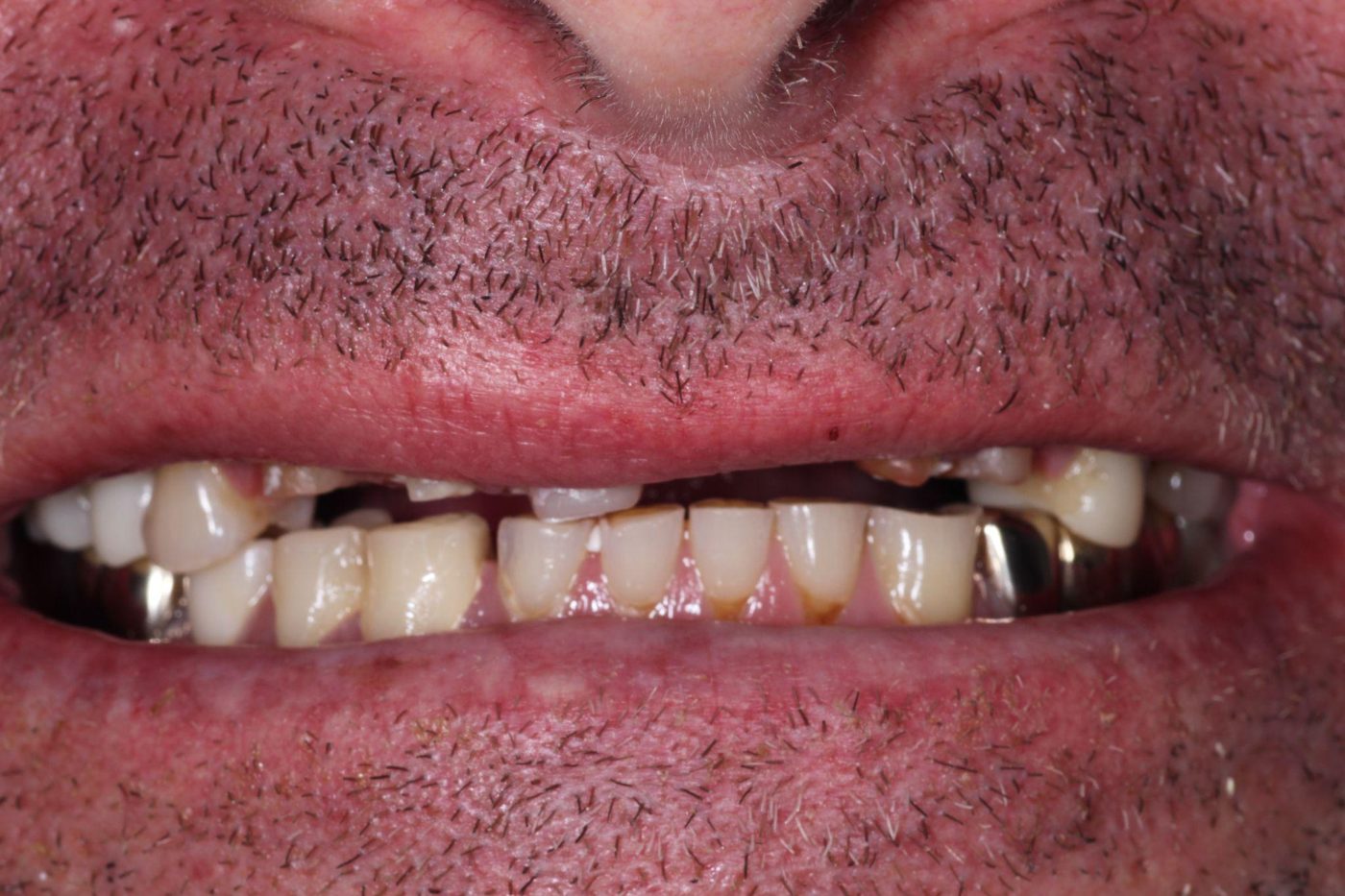 Before: severe dental breakdown and missing teeth before implant reconstruction, Clermont FL