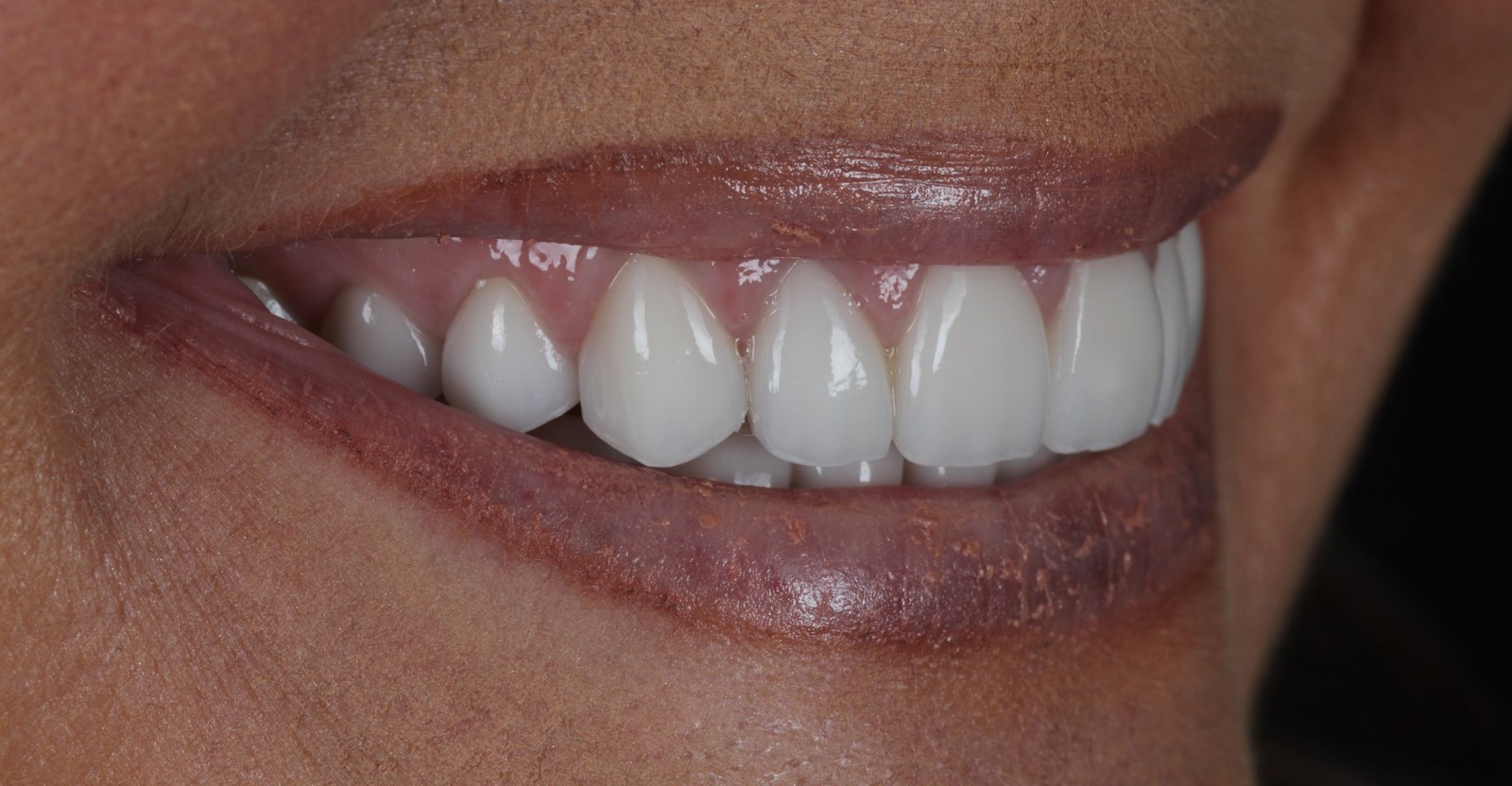 Natural porcelain veneers by Dr. Seth Calish, cosmetic dentist in Clermont FL