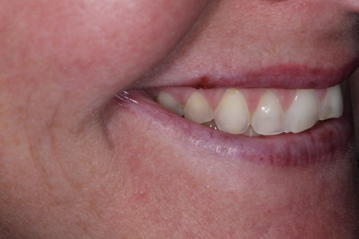 Before: side view of smile before veneers, Clermont FL