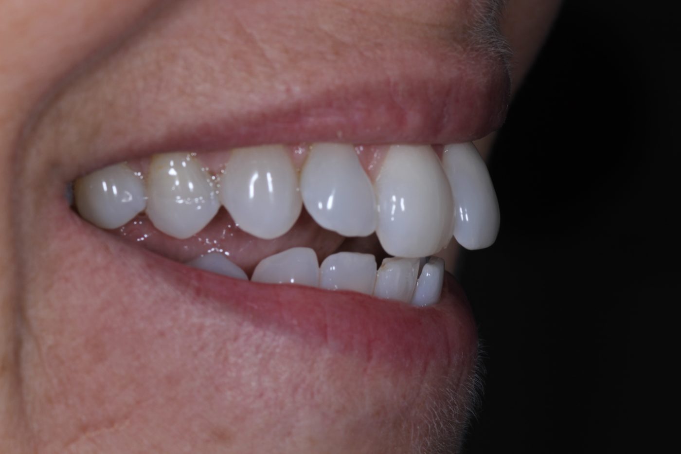 Before: crowded, misaligned teeth before clear aligner treatment by Dr. Seth Calish, Clermont FL